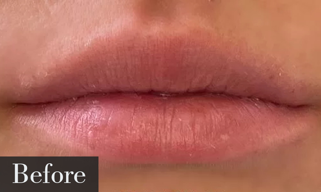 Before Lip Treatment image